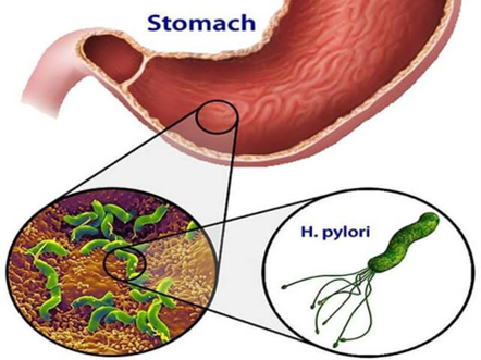 H. pylori