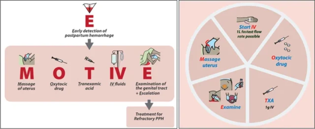 WHO MOTIVE Bundle for Postpartum Hemorrhage Management 2025