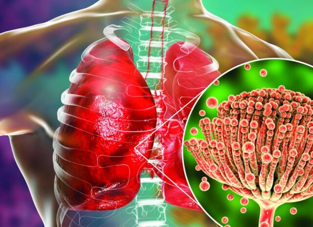 Global Burden of Pulmonary Fungal Diseases Update: The “Silent Killer” Challenging Modern Medicine